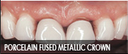 porcelain fused metallic dentist fresno ca