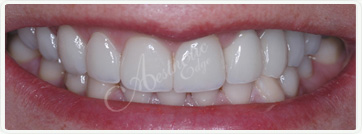 cost of teeth whitening fresno