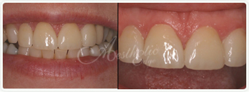 Before and after Dentist Fresno