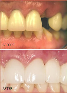 dental and dentures