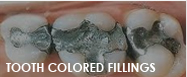 tooth colored fillings fresno ca