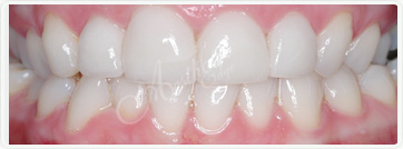 teeth whitening fresno