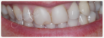 teeth whitening dentistry fresno
