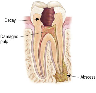 Painful tooth needs root canal dentist