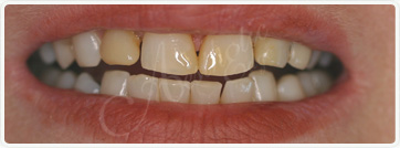  Before Fresno Dentist Mankirat Gill corrected the gummy smile