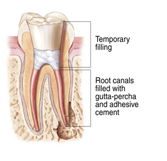 root canal therapy completed successfuly